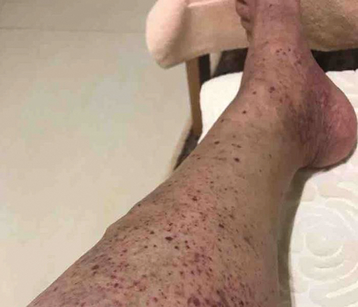 Image showing A purpuric rash over the patient’s right calf, characteristic of leukocytoclastic vasculitis.