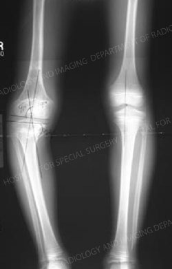 X-ray image of limb length discrepancy due to growth plate injury