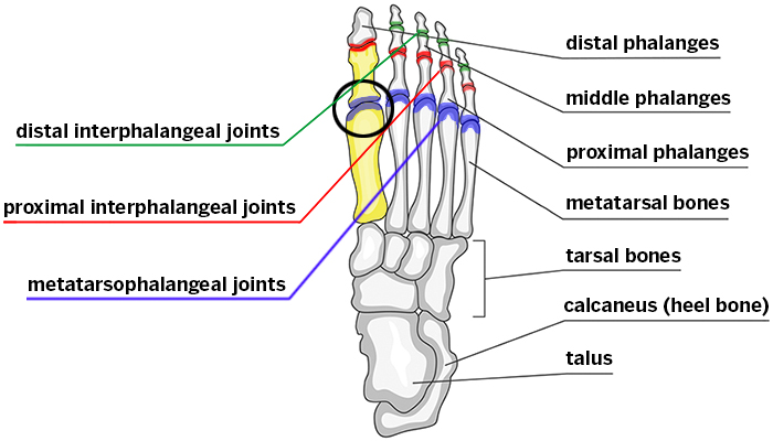 hallux rigidus (stiff gig toe)