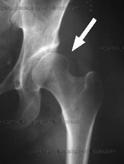 dysplastic hip with poor head coverage from an article about hip arthroscopy