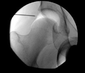 fluoroscopic image of traction creates space for instrument insertion from an article about hip arthroscopy