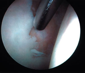 image of cleaning away torn cartilage from an article about hip arthroscopy