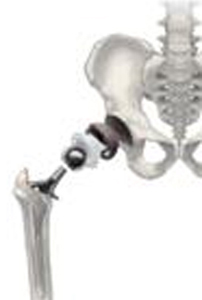 3D image showing total hip replacement