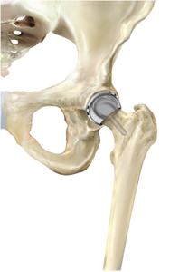 3D image showing hip resurfacing