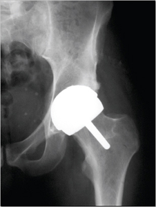 X-ray image showing hip resurfacing