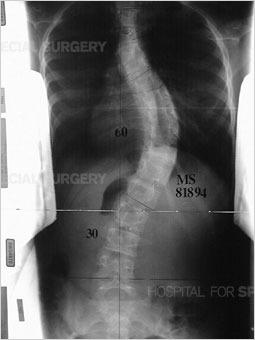 X-ray image showing scoliosis in the thoracic and lumbar spine.