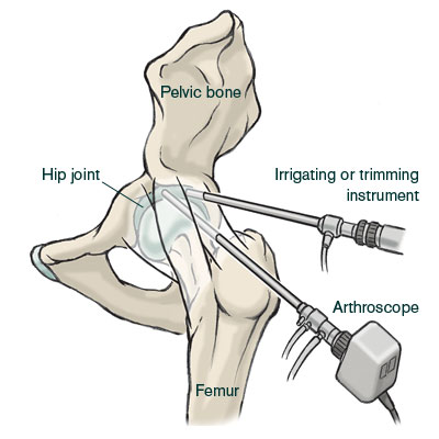 illustration of a hip arthroscopy