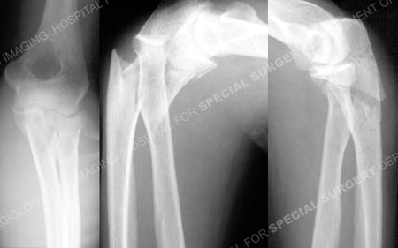 Injury Radiographs revealing Monteggia fracture-dislocation from a case example from the orthopedic trauma service at Hospital for Special Surgery.