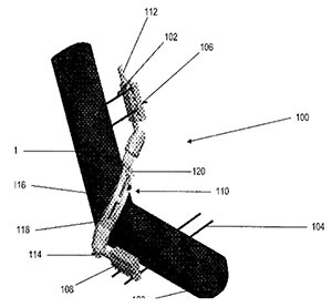 Diagram of external fixation device