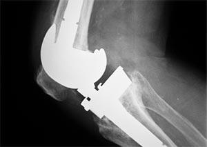 X-ray image of a knee revision