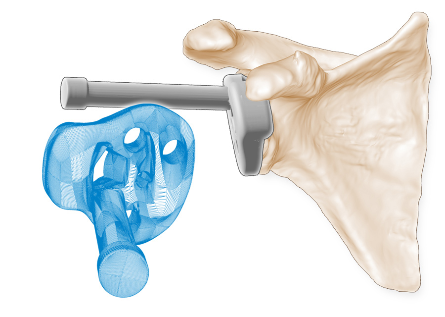 Graphic illustration of shoulder instrumentation