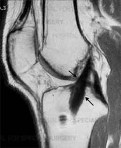 MRI image of a healthy ACL.