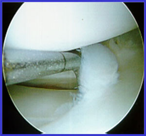 What is the recovery time for a minor meniscus tear surgery?