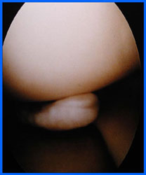 Arthroscopy photo showing meniscus tear.