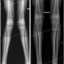 Before and after X-ray of knock knees