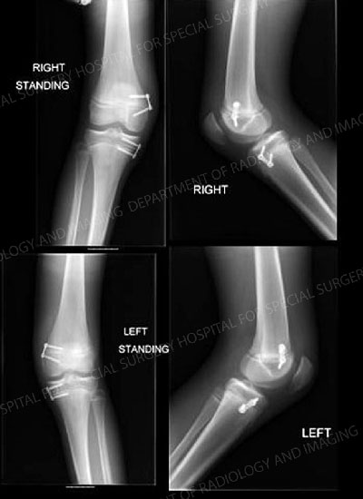 Postoperative knee X-rays demonstrating surgical hemi-epiphysiodesis utilizing eight-Plate devices