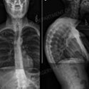 X-ray image of a patient with Kyphosis