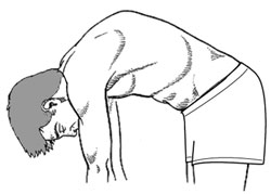 Graphic: Illustration of increased prominence from Kyphosis with forward bending.
