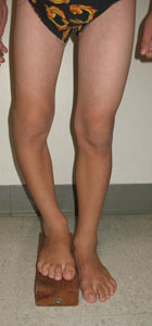 Young patient with a leg limb length discrepancy