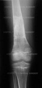 X-ray image of the heeled bone seven months after limb lengthening surgery.