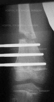 X-ray image of an osteotomy of the femur showing two inches of lengthening after two months.