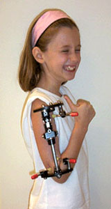 Photo of a pediatric limb lengthening patient