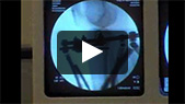 Live Surgery Demonstration of Proximal Tibial Ostectomy for Bilateral genu varum, using the Ilizarov/Taylor Spatial Frame