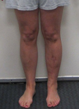 Photo of Erin's legs after surgery