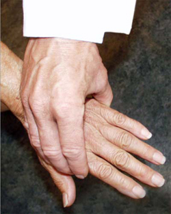 Photo of a physician performing a squeeze test of the MCP joints of the hand.