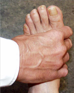 Photo of a physician performing a squeeze test of the MCP joints of the foot.