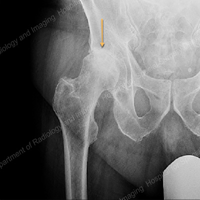 X-ray view of the hip joint showing osteoarthritis and joint space narrowing.
