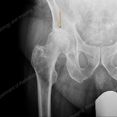 osteoarthritis 2 3 szakasz