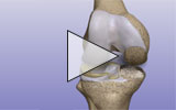 Image - partial knee replacement
