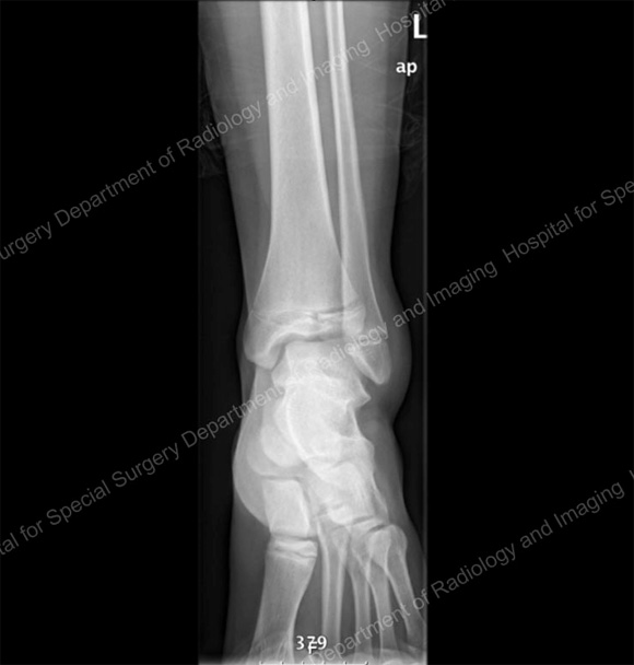 Image: Anterior X-ray of a displaced tibial fractur
