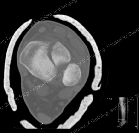 Image: Cross-sectional CT scan of a displaced tibial fracture