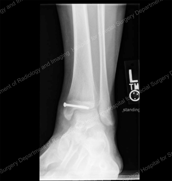 Image: X-ray showing surgical correction of the tibia with screws