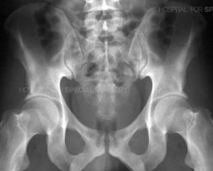 What are the surgical options for a pelvic fracture?