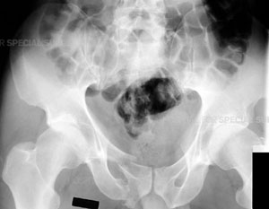 A radiograph of a pelvis demonstrating a fractured pubic bone from an article about Pelvic Fractures/Acetabular Fractures