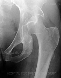 Radiograph of the left hip demonstrating a posterior dislocation of the hip.