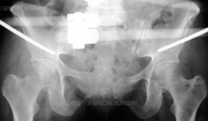 Radiograph of a pelvis demonstrating application of a pelvic externatal fixator from an article about Pelvic Fractures/Acetabular Fractures