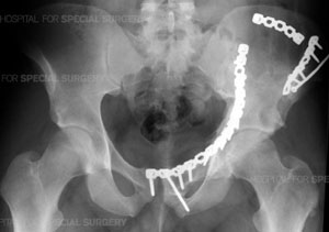 Radiograph of a pelvis following surgery from an article about Pelvic Fractures/Acetabular Fractures