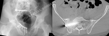 postoperative pelvic radiographs and ct scans hardware placement from a case example of polytrauma presented by the orthopedic trauma service at Hospital for Special Surgery.