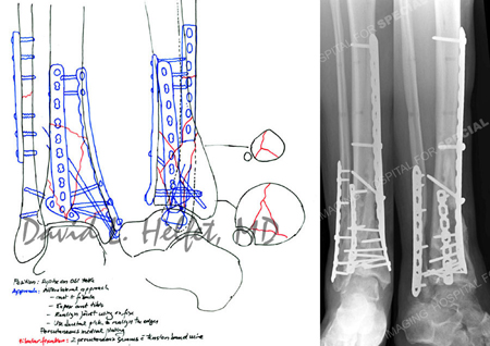 Preoperative plan for open reduction and internal fixation from a case example presented by the Orthopedic Trauma Service at Hospital for Special Surgery.