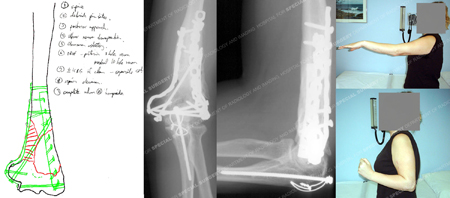 Pre-operative plan for placement of bone graft, and imagery 25 months after distal humerus fracture surgery from Case Example from the Orthopedic Trauma Service at Hospital for Special Surgery.