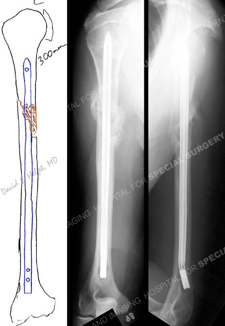 preoperative plan and radiograph of healed mid-shaft pathologic humeral fracture from a case example presented by the orthopedic trauma service at Hospital for Special Surgery.