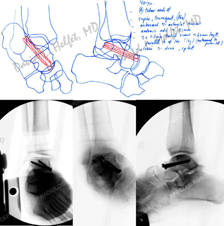 preoperative plan and fluoroscopic images following ORIF from a case example of a talus fracture from the orthopedic trauma service at Hospital for Special Surgery. 