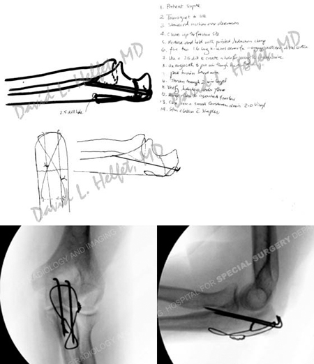 preoperative plan and intraoperative fluoroscopic radiographs following ORIF from a case example of an ulna fracture from the orthopedic trauma service at Hospital for Special Surgery.