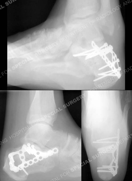 Heel radiographs 5 years after surgery revealing a healed calcaneous fracture in alignment from Orthopedic Trauma Service at Hospital for Special Surgery
