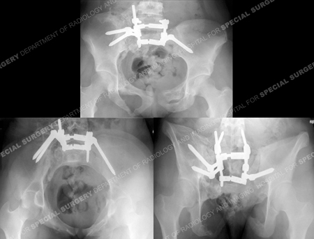 Pelvis radiographs 19 months following operation from a case example of pediatric pelvic fracture from the orthopedic trauma service at Hospital for Special Surgery.