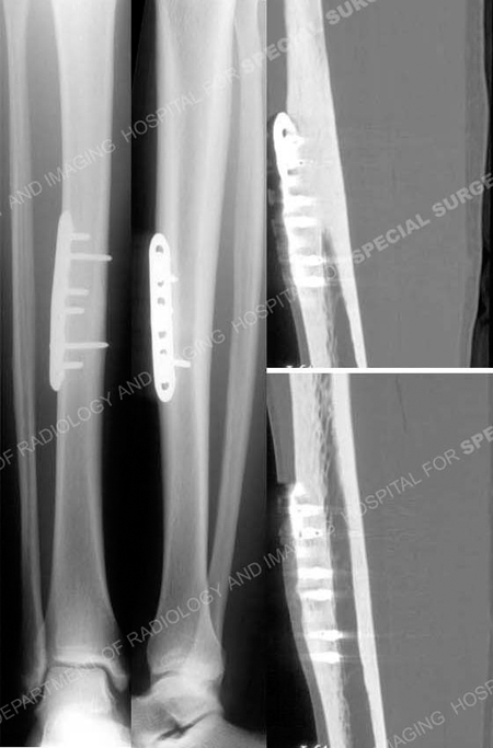 radiographs and CT scan images revealing healed tibial stress fracture from a case example presented by the orthopedic trauma service at Hospital for Special Surgery.